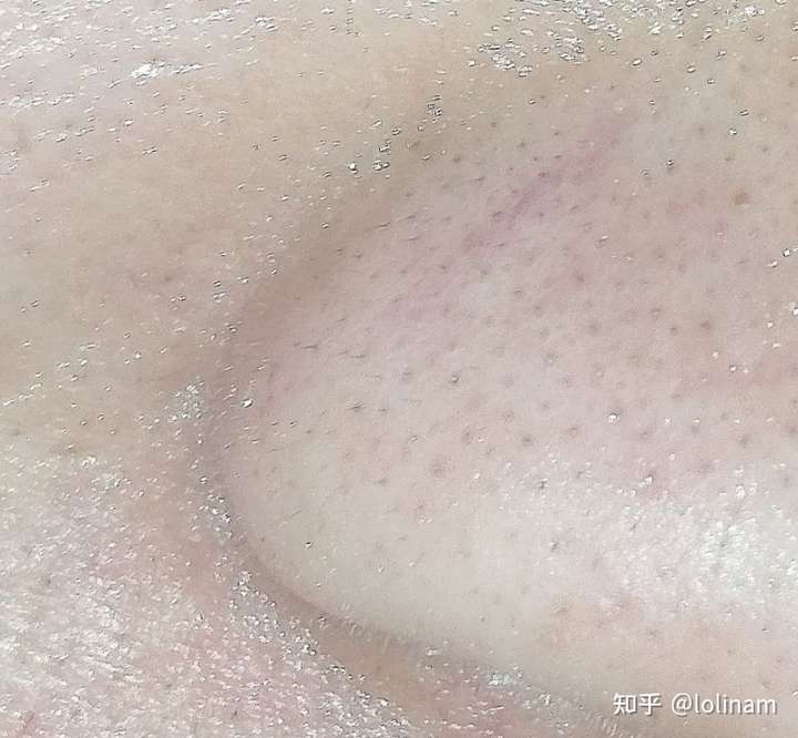 当然越粗越硬的黑毛或者小刺毛越容易和黑头混淆,仔细看,下图其实是