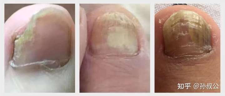 甲萎缩,甲残留:感染时间1年以上,指甲增厚 发黄 有碎屑,甲面凹凸
