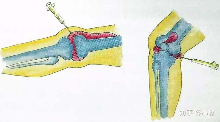 在临床上很容易就被诊断为"滑膜炎". 积液最好的处理方法还是: 穿刺