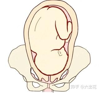 顶先露(图片来源于网络)