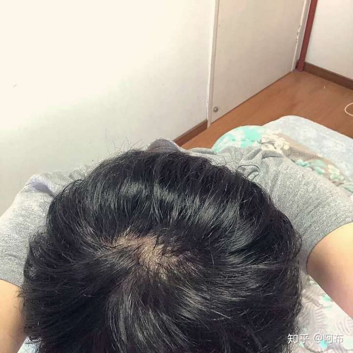 我才18岁就脂溢性脱发,心态崩了,怎么办?