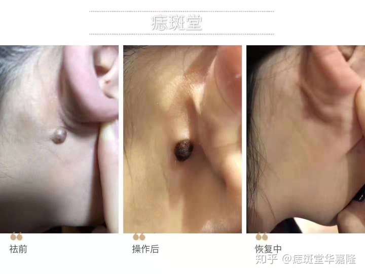 我们中药取痣,不留疤,不忌口,不忌水可洗脸洗澡