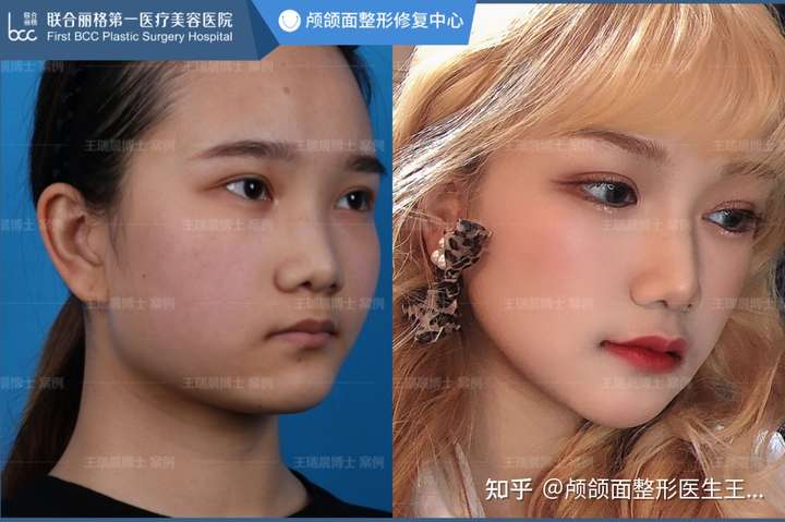 请问我这个是下颌角外翻吗?