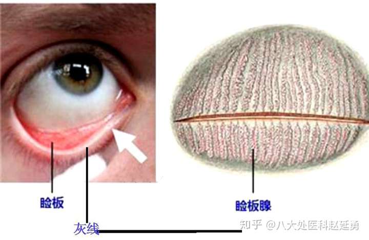 双眼皮手术是否会导致干眼症?