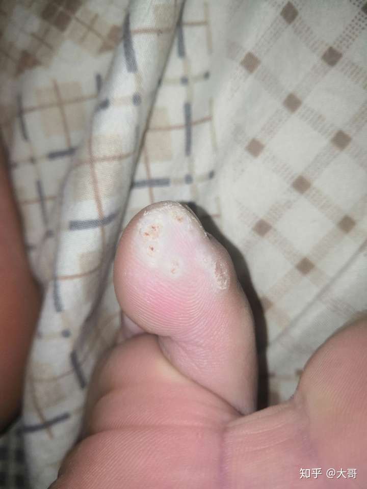 怎么分辨脚上长得是鸡眼还是疣?