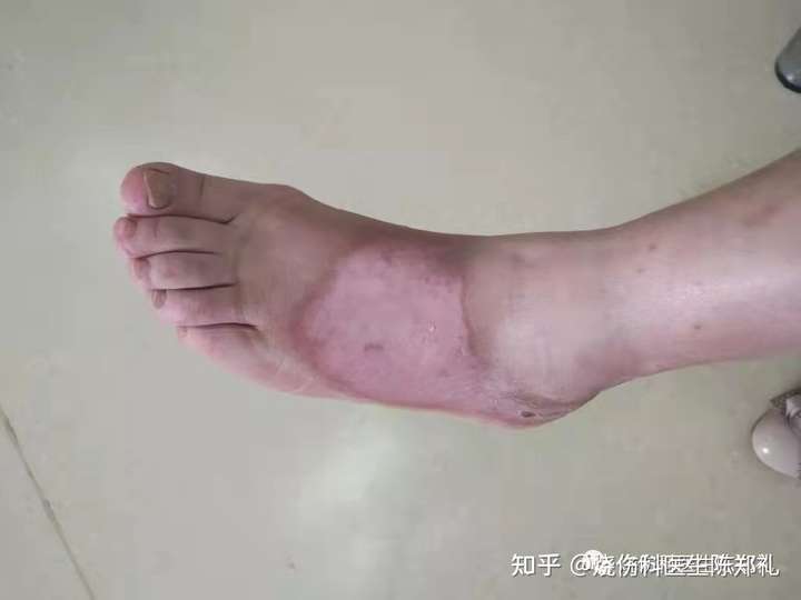 作为一个真正治疗过氢氟酸灼伤患者的烧伤科医生,我来回答一下这个