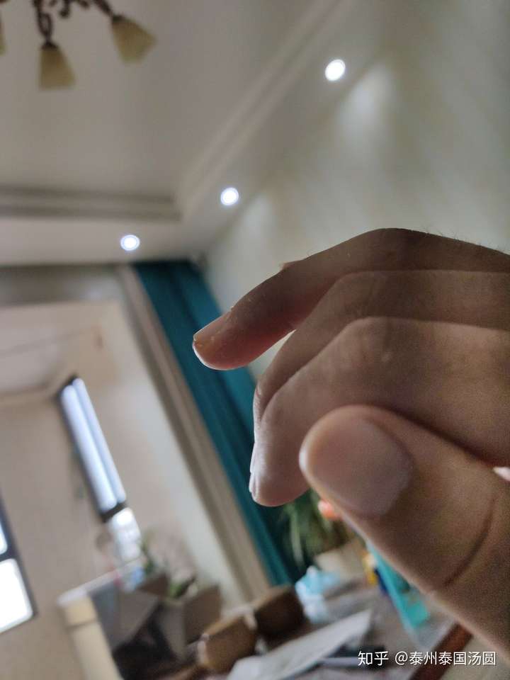 手指肌腱断裂,最后一节无法伸直.医生教我不要治疗了.