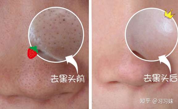 曾经仗着仗着自己的好皮肤使劲的作,后来鼻子上密密麻麻的黑头都能