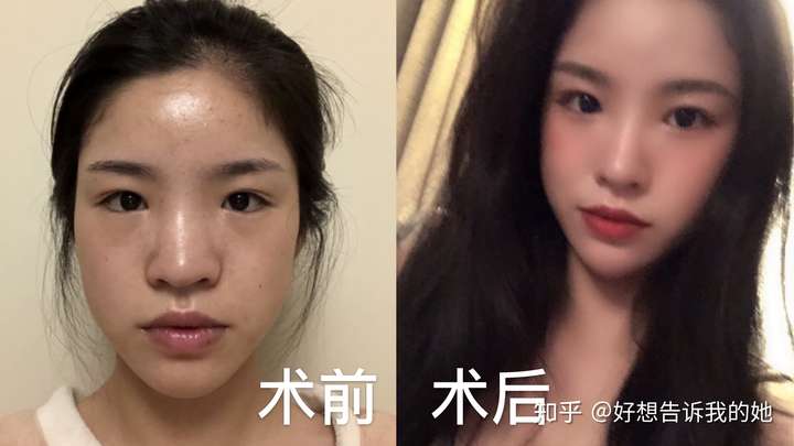 哪里可以做妈生款自然隆鼻?