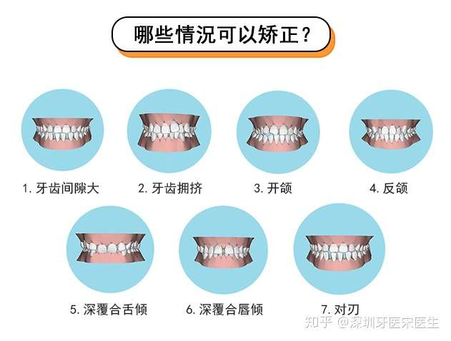 几个大概标准①牙齿畸形②牙齿缺损③牙齿"歪"斜④牙齿咬合不好