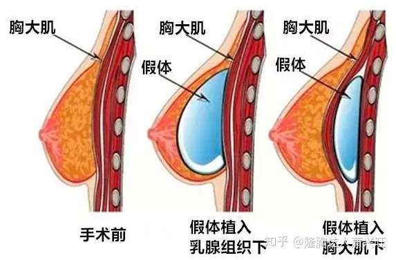 今年16岁的女生,想要丰胸(目前b 想要到c)该怎么做?