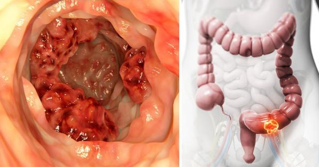左:菜花状直肠癌;右:发病位置
