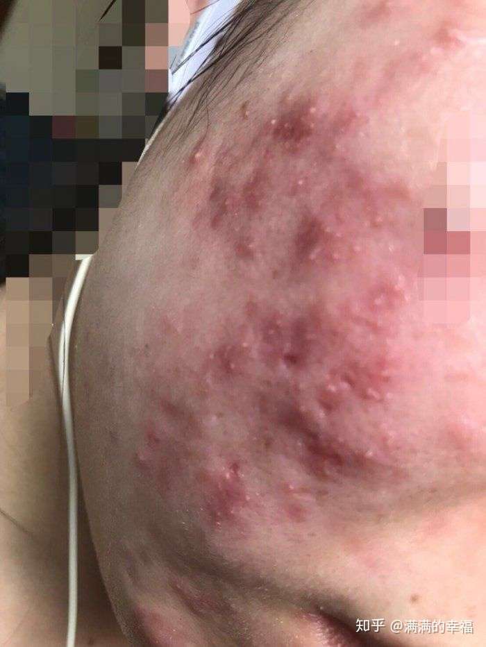 下面是我痘痘恢复过程记录,照片比较恐怖,胆小者不要往下翻看了(这是
