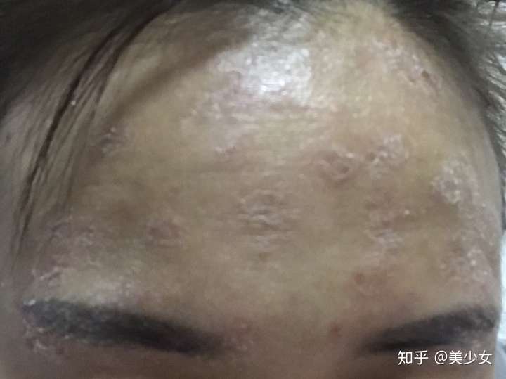 皮肤过敏,发红,干燥起皮还发痒怎么办?