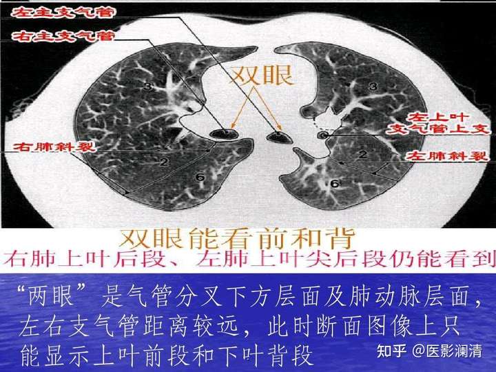肺部五叶十八段在ct上怎么具体划分呢?