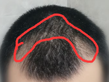 大概是三级脱发 的样子 两个额角后移严重,头顶略微有稀疏