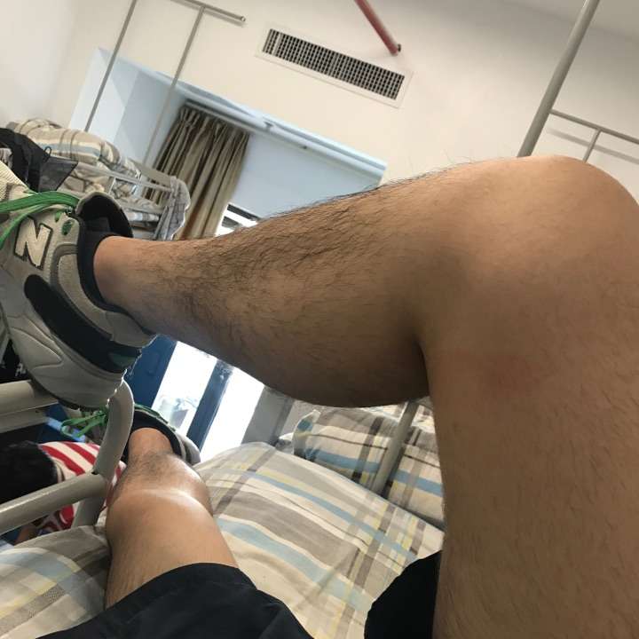男生腿毛浓密怎么办?