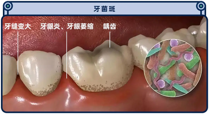 位小白鼠,噢不,好心的同事,分别给他们的牙齿涂上 牙菌斑指示剂