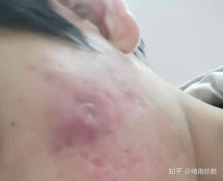 囊肿型痘痘怎么消下去?
