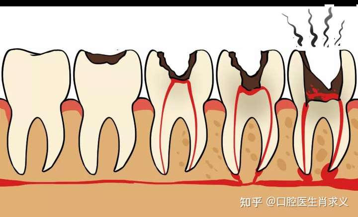 神经痛,牙髓炎