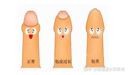 1,包皮过长弊大于利