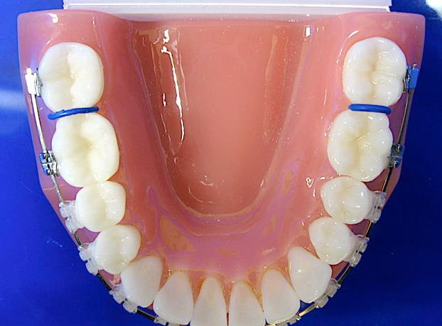 这个叫分牙圈,作用是是把基牙和临近的牙分出来一定间隙,大概是在0.