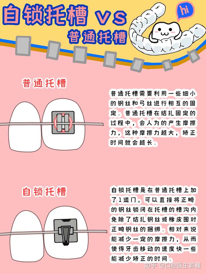 自锁托槽的优势和不足