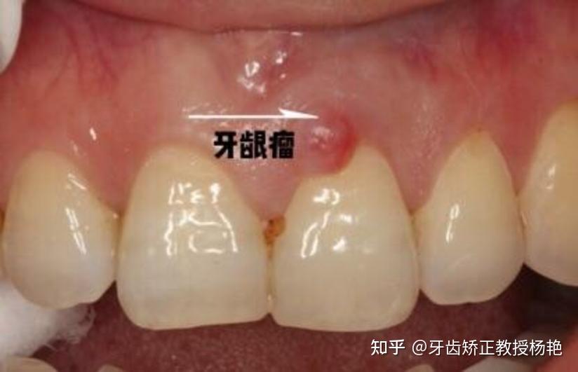 专业上这样描述的:来源于牙周膜及颌骨牙槽突结缔组织的炎性增生物或