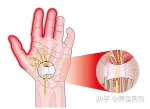 腕管综合征有哪些表现致病原因是什么该如何预防和治疗呢