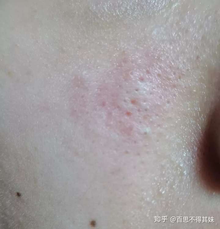 毛孔大怎么处理?