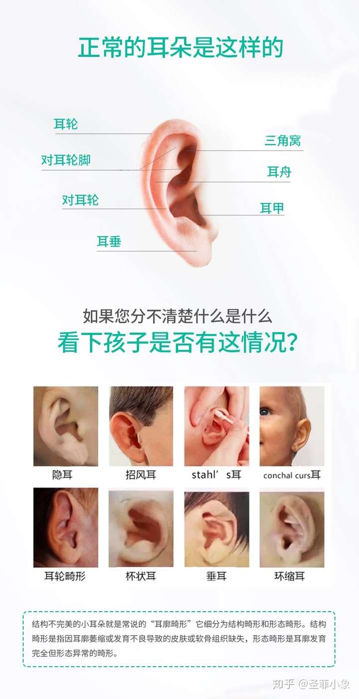 什么是耳廓矫正贴?