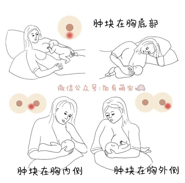 哺乳期 急性乳腺炎化脓的宝妈选择断奶了吗?