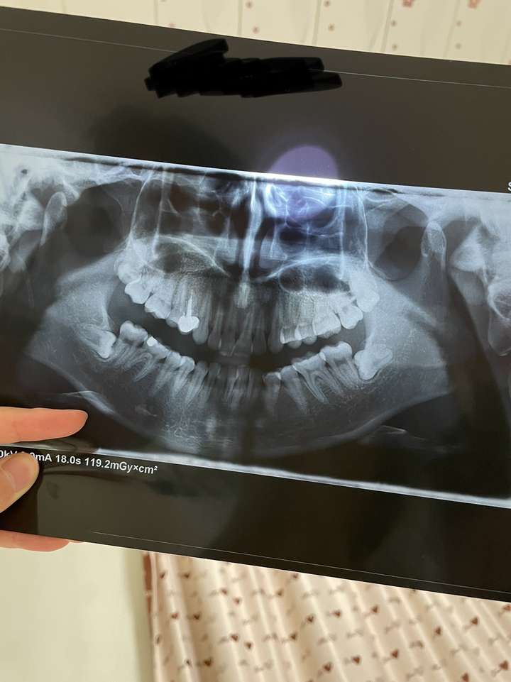拔完智齿后那一周你经历了什么?