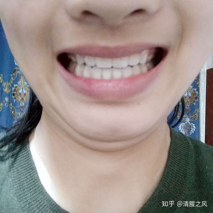 第一次戴牙套保持器什么体会?