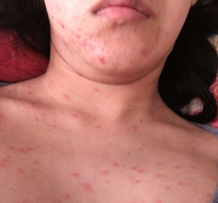 长水痘是一种怎么样的体验