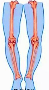 我的o型腿严重吗?怎么矫正?