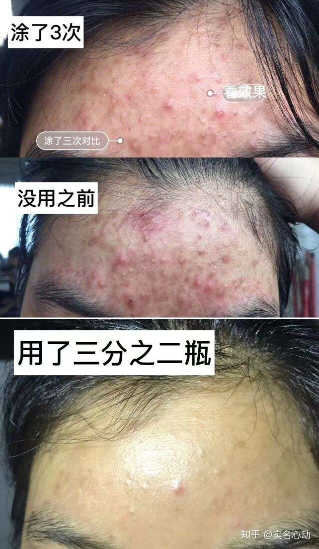 严重爆痘到烂脸怎么办?