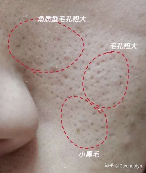 我脸上的黑头怎么办求救