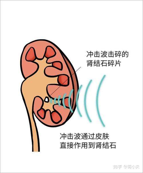 肾结石怎么排出肾下盏结石3招快速排出