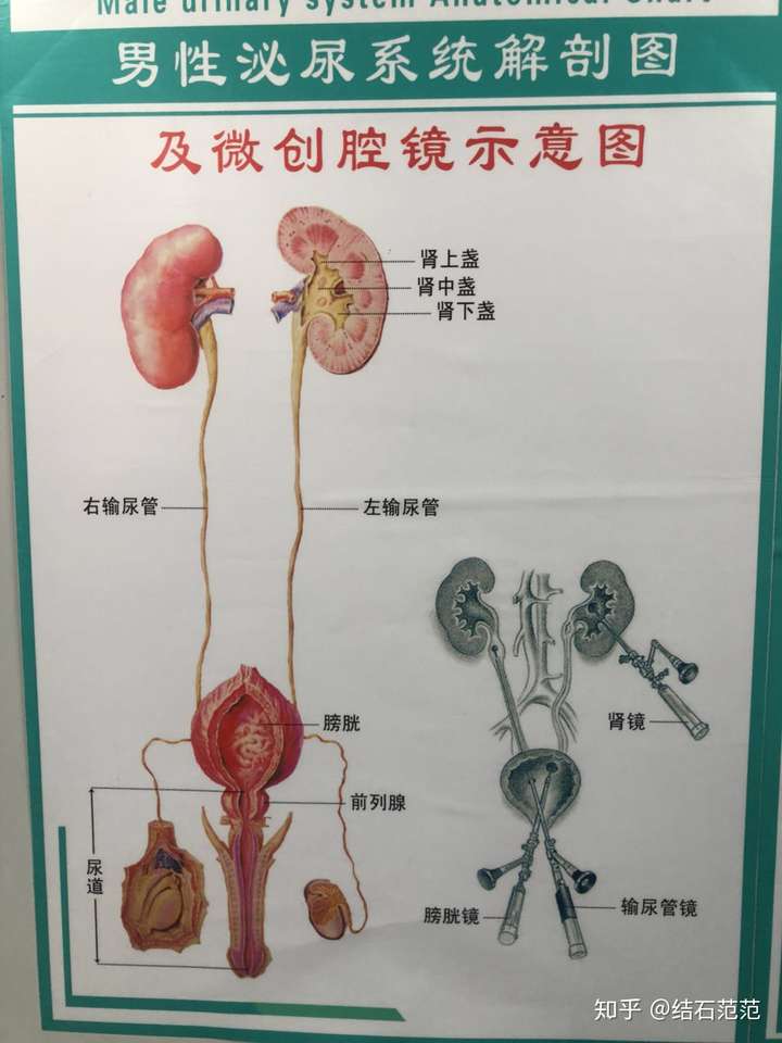 肾结石所在有很多位置,上面分为肾盏,肾盂,输尿管,其实都分左右.