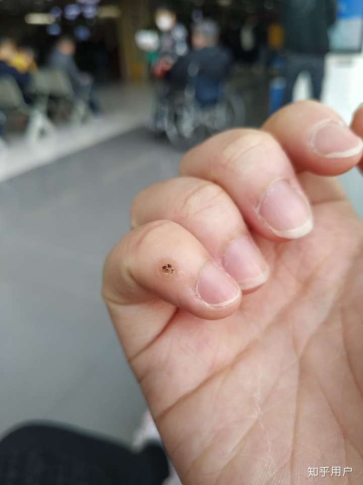 激光去疣有多痛