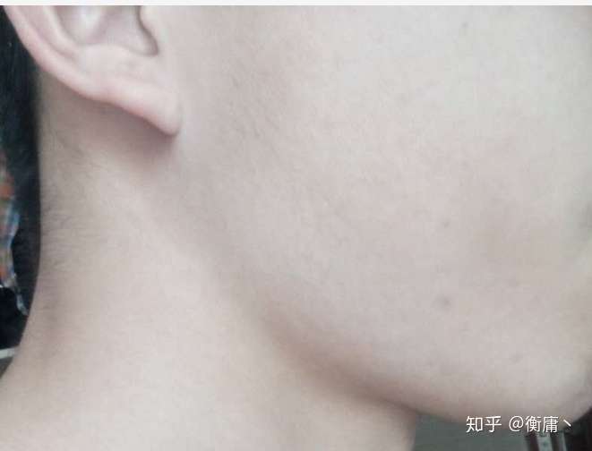 我这个算咬肌大还是下颚大呀?
