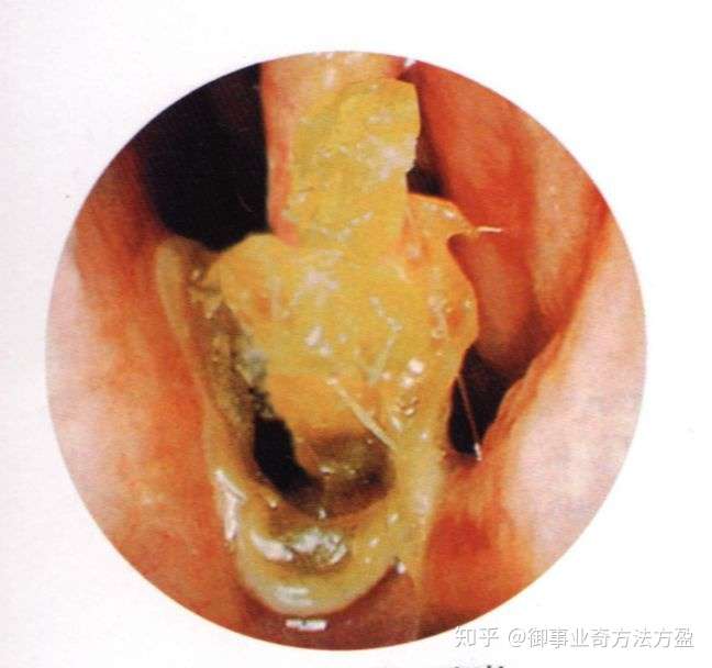 求助,萎缩性鼻炎可以治疗么?