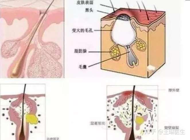 皮脂腺分泌旺盛 知乎