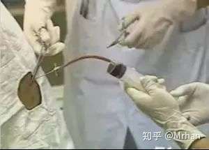 四大穿刺之胸穿