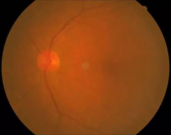 这是一个重度白内障患者的眼底照片,我们已经看不清楚眼底的结构了.