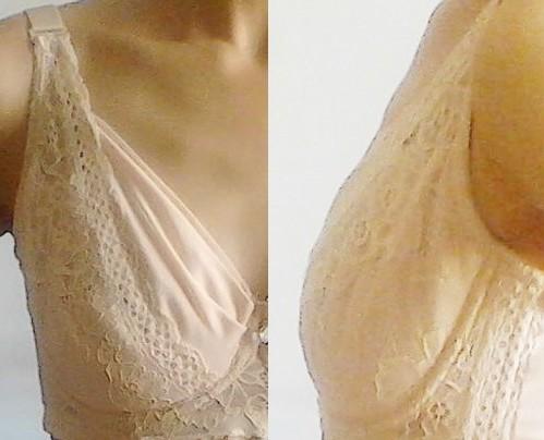 杯口向内陷,除了乳房"主体"偏向的影响,乳房上部的凹陷(裸胸图片中圈
