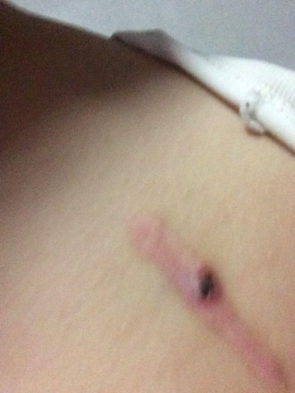 心脏起搏器的刀口破了出血是为什么?