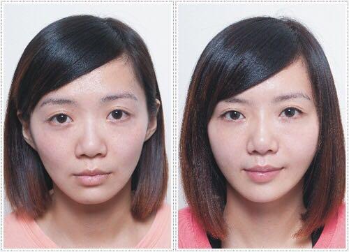 为何戴 牙套 会形成 牙套脸 ? - 美容护肤 - 知乎