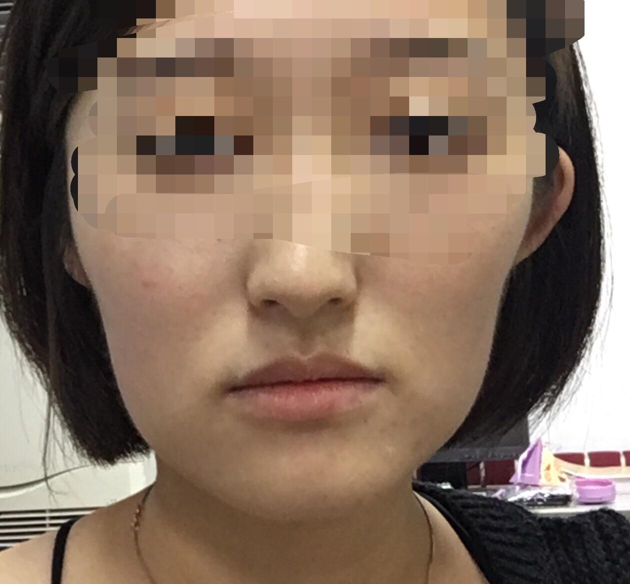 蛋白刀和面人线提升哪个好一点?-绘食品的回乐超声美图片